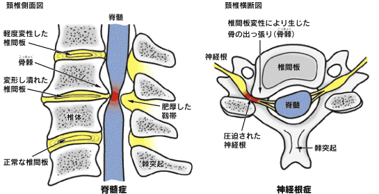 頚椎症（神経根症、脊髄症）、頸椎椎間板ヘルニア