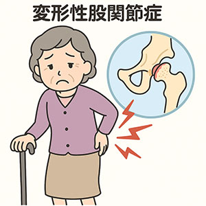 変形性股関節症